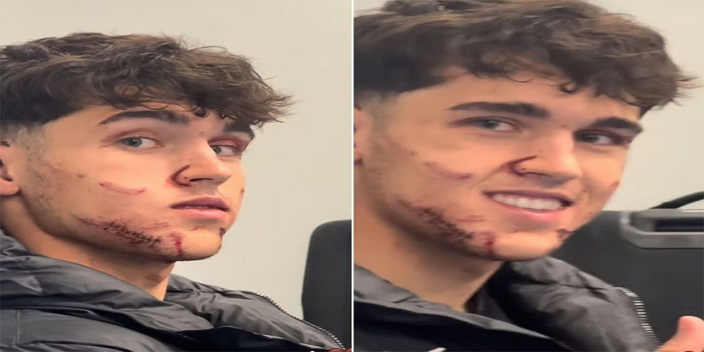 مصدومیت هاورتز جدی است: بازی با درد و بخیه