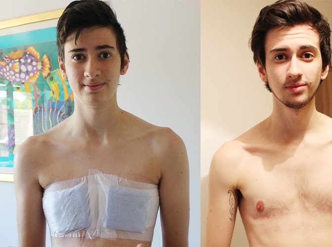 تغییر جنسیت مرد به زن ساخت سینه